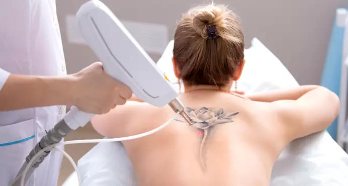 WIN 3 laser tattoo removal sessions up to a max of 20cm x 10cm