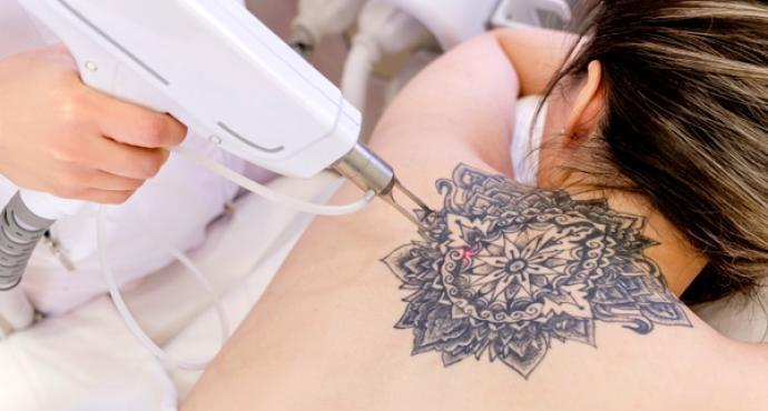 Win Laser Tattoo Removal